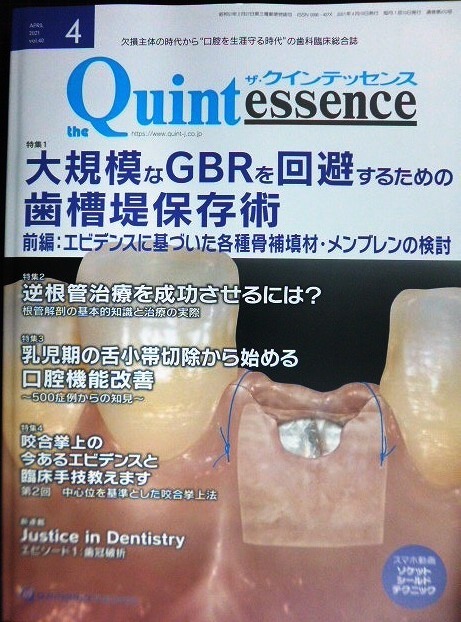 画像1: the Quintessence クインテッセンス 2021年4月号★大規模なGBRを回避するための歯槽堤保存術